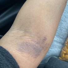 An eczema flare-up on the arm.
