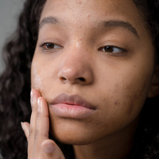 A black woman with eczema, showing the importance of supporting eczema treatment and minority-owned businesses.